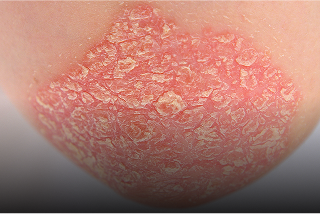 Psoriasis-banner