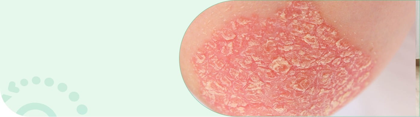 Psoriasis-banner