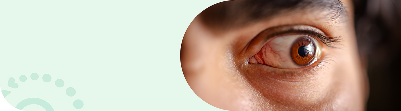  Enfermedad Ocular Tiroidea