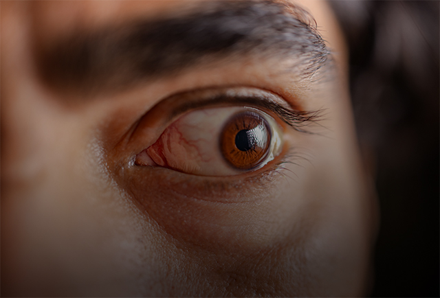  Enfermedad Ocular Tiroidea