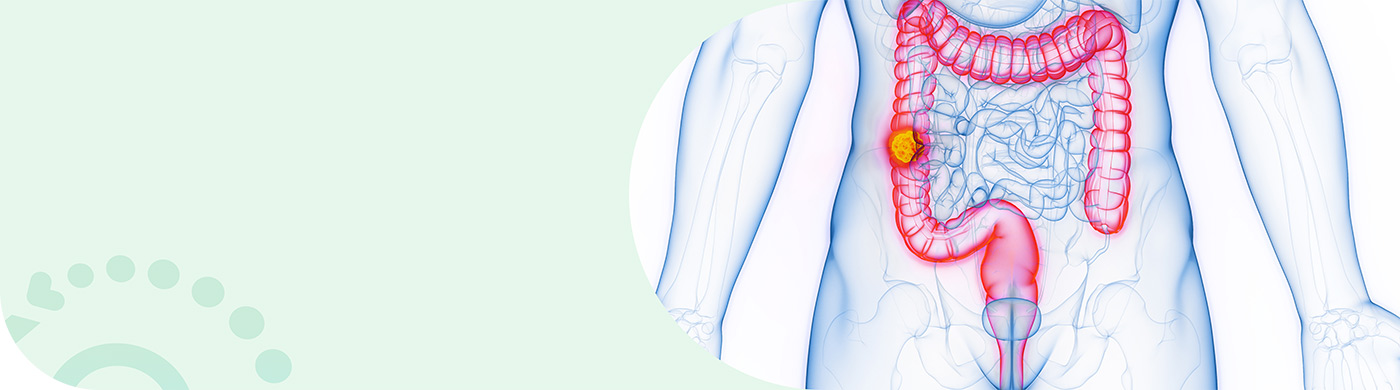 Cáncer colorrectal metástasico