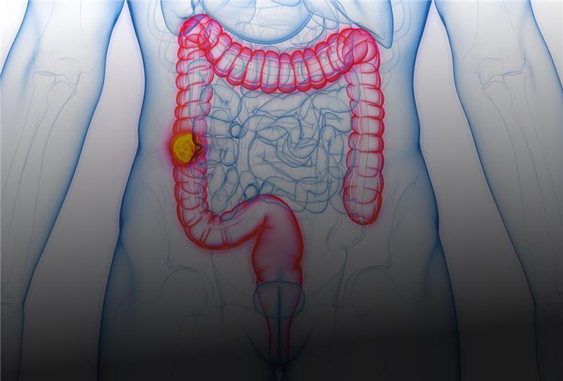 Cáncer colorrectal metástasico