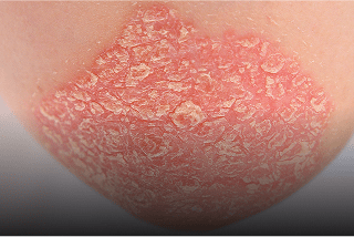 Psoriasis-banner